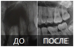 Киста зуба лечение