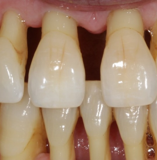 Пародонтоз - заболевание десен, при котором выпадают зубы